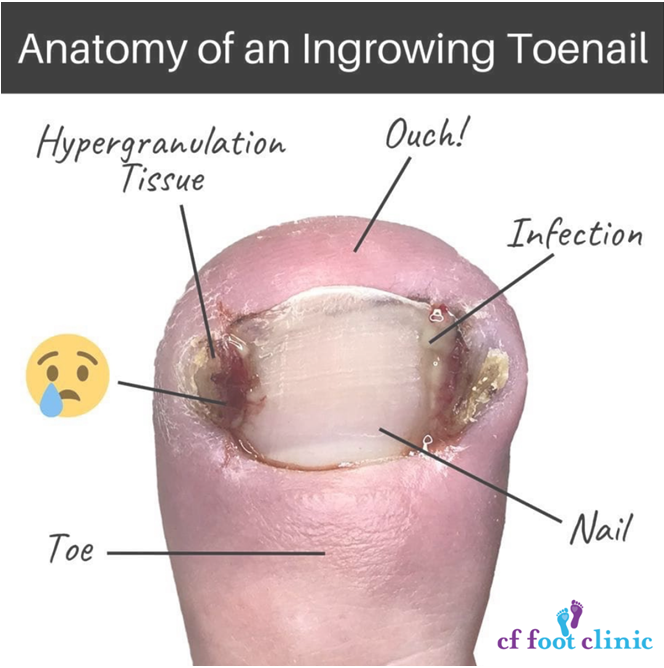 Graphic showing the anatomy of an ingrowing toenail