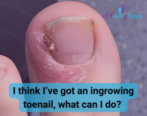 Graphic showing an ingrowing toenail