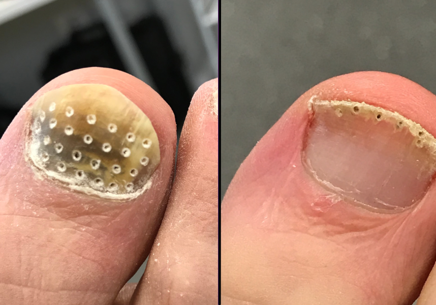 Before and after a toenail has been treated with fungal nail treatment