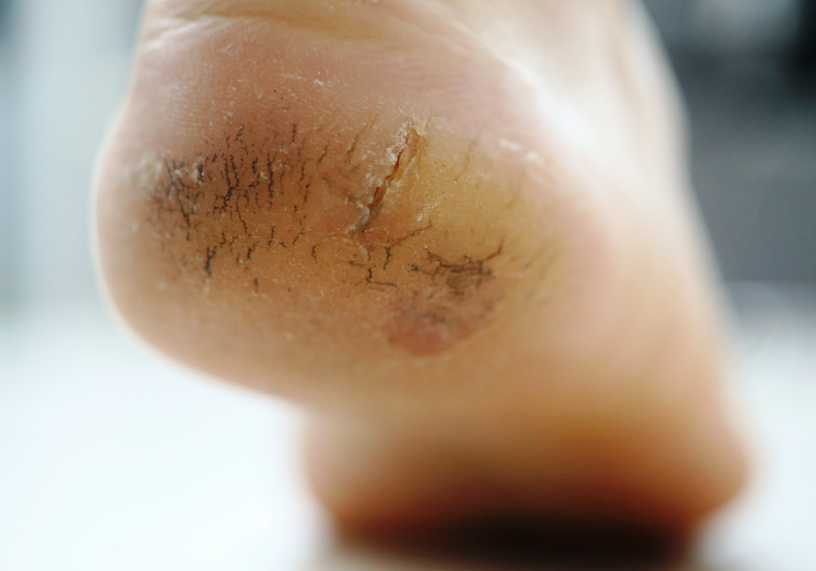 A foot with cracked skin on the heel