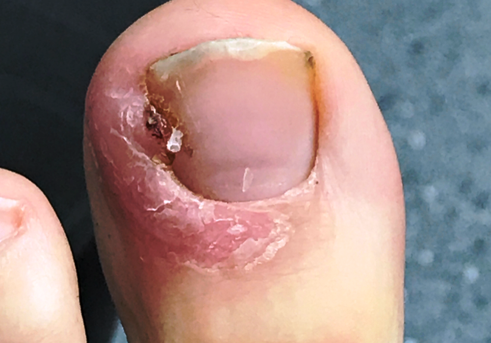 An ingrowing toenail possibly requiring surgery
